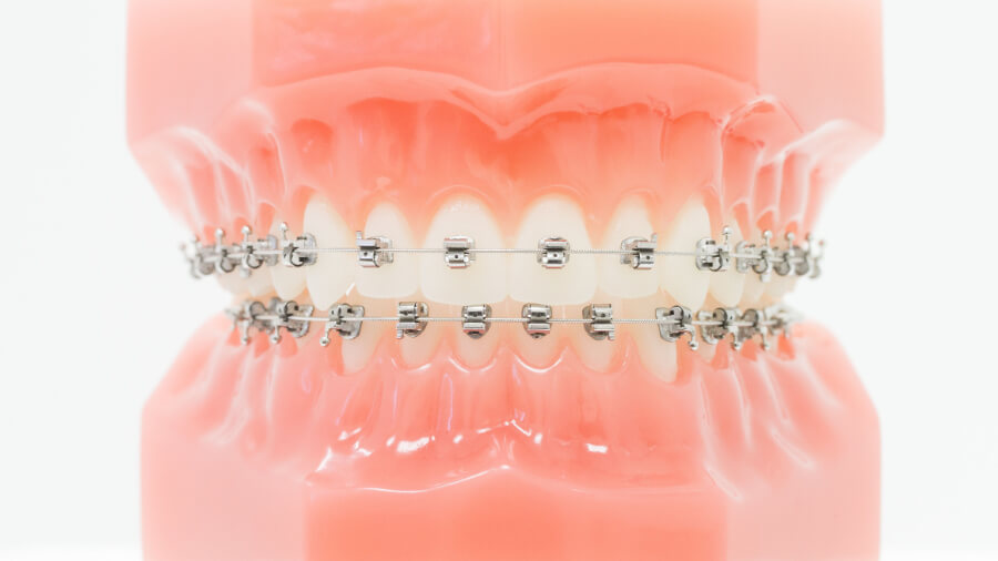SPEED-Bracket-System auf einem Studienmodell